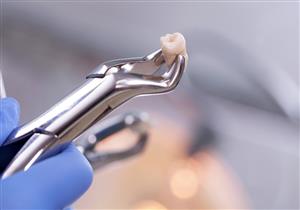 كيف يؤثر خلع الضرس على باقي الأسنان؟