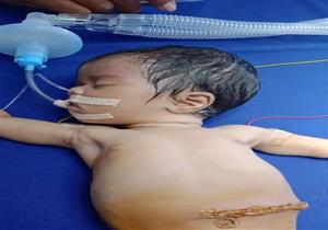 ولادة طفلة داخل بطنها 8 أجنة في الهند