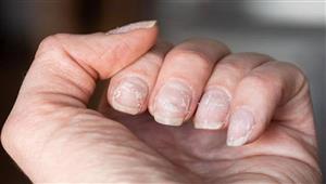 ماذا تقول يديك عن صحتك؟.. 7 أسرار عليك معرفتها