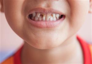 الأسنان اللبنية عند الأطفال معرضة للتسوس- ماذا تفعل الأم لحمايتها؟