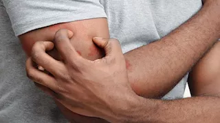 دكتورة جلدية: يجب علاج هذه الأعراض لعدم التأثير على تركيز طالب الثانوية  