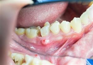 الفرق بين خراج اللثة والأسنان– متى تزور الطبيب؟ 