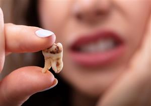 أغذية قد تهدد أسنانك بالتسوس والتصبغات- أغربها الموز