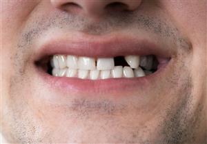 تأثير كورونا على الفم- هل يسبب فقدان الأسنان؟