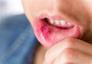 5 أسباب لتورم سقف الفم- إليك طرق العلاج