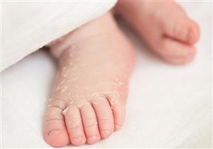 لماذا يتقشر جلد الرضع بعد الولادة؟