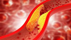 علامة تحذيرية تشير لارتفاع مستوى الكوليسترول في الدم