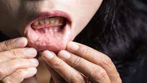 لا تتجاهلها- علامات قد تكشف الإصابة بسرطان الفم