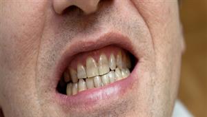 4 أضرار محتملة للإفراط في تنظيف الأسنان