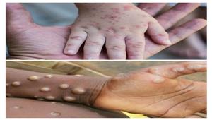 صداع وطفح جلدي.. نقابة الأطباء البيطريين تكشف بداية أعراض "جدري القرود"