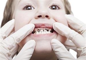دليلِك لحماية أسنان طفلِك من التسوس