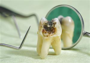 يهدد النساء أكثر من الرجال- طبيب يكشف أسباب تفتت الأسنان
