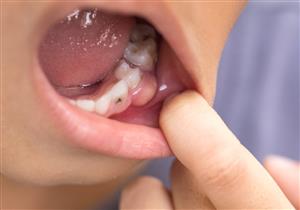 خراج الأسنان واللثة- طبيب يوضح الفرق بينهما