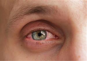 هل تؤثر الحمى على صحة العين؟