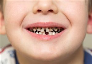 عادات غذائية خاطئة تهدد أسنان طفلِك بالتسوس- 6 نصائح للوقاية
