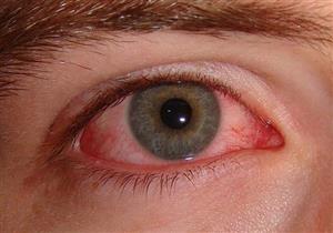 التهابات المفاصل تؤثر على العينين– حقيقة أم خرافة؟