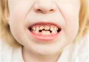 لماذا يتغير لون أسنان الطفل في مرحلة النمو؟