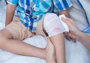 علاج حروق الأطفال- 5 أخطاء شائعة بين الأمهات 