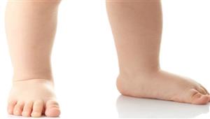 هكذا تتعرف على القدم المسطحة لدى الأطفال
