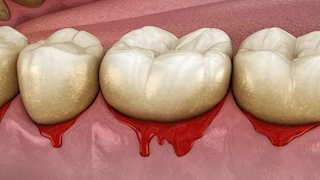 "يا دكتور أسناني تنزف عند التنظيف".. طبيب يكشف الأسباب والمضاعفات 