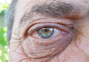 بارقة أمل- دواء جديد يحمي مرضى الضمور البقعي من العمى