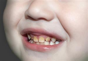 طفلك يعاني من اصفرار الأسنان؟- 8 أسباب محتملة