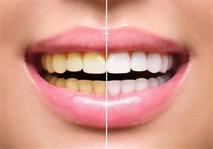 ما مدى فعالية لصقات تبييض الأسنان؟