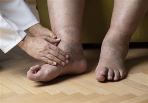 أسباب تغير لون قدم مريض السكري- طبيب يحذر: علامة خطيرة