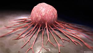 اليوم العالمي للسرطان- طبيبة: جميع الأورام السرطانية قابلة للشفاء في هذه الحالة