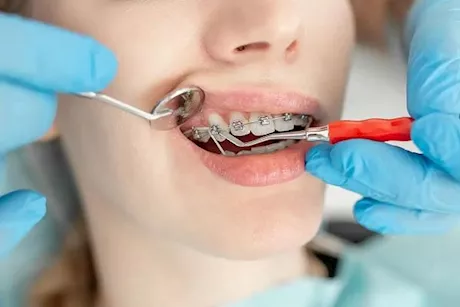ما أسباب فشل علاج تقويم الأسنان؟