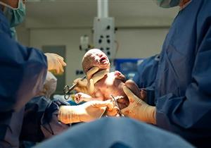 أطفال الولادة الطبيعية Vs القيصرية- أيهما يتمتع بمناعة أقوى؟