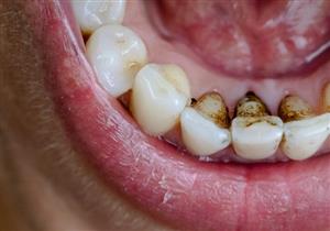 مضاعفاته خطيرة- دليلك لتجنب جير الأسنان الأسود