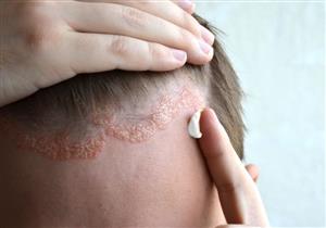 أسباب إكزيما الشعر وأعراضها- كيف تتخلص منها؟