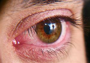 حسب النوع- ما الذي يسبب جفاف العين؟
