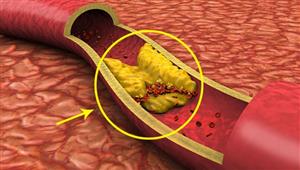 قد يجهله البعض.. العرض الأول لانسداد الشرايين بسبب الكوليسترول 