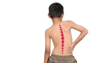 اعوجاج العمود الفقري عند الأطفال- كيف يمكن علاجه؟