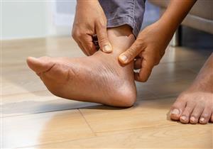 لمرضى السكري- حسام موافي يحذر: تورم القدمين عرض لهذه الأمراض