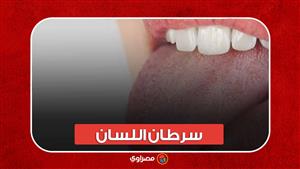 أخرهم اليوتيوبر "فالنتينو" سرطان اللسان .. علاماته وعلاجه؟