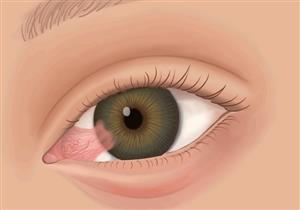 اللحمية تظهر في العين أيضًا- إليك أسبابها وطرق علاجها