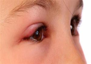 تورم العين المفاجئ عند الأطفال.. إليك الأسباب والعلاج