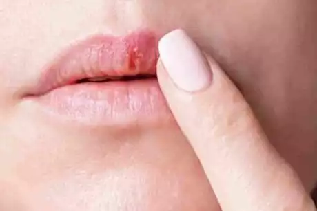 الشفاه مرآة صحتك.. علامات لا تتجاهلها