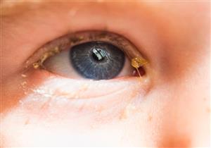 علاج إفرازات العين في المنزل- 5 طرق تستحق التجربة