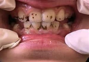 أنواع تصبغات الأسنان- أيها أكثر صعوبة في إزالتها؟