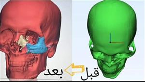 جراحة تجرى للمرة الأولى.. إعادة بناء ملامح وجه حالة تعرضت لحادث بالإسكندرية- صور