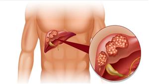 احذر.. علامات إذا ظهرت عليك في رمضان تدل على سرطان الكبد