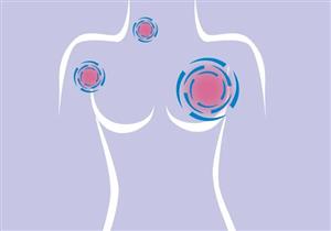 طبيب يوضح أخطر أنواع سرطان الثدي "فيديو"
