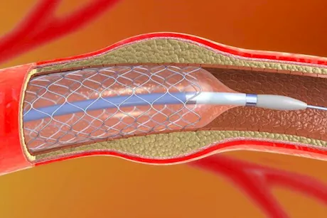 بعد تركيب دعامات القلب.. نصائح مهمة لا تغفلها