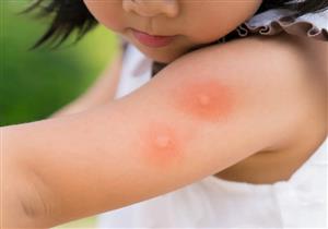 احذري- مرض يجعل لدغات الحشرات أكثر تأثيرًا على طفلِك