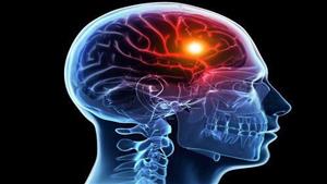 أعراض خطيرة- ماذا يحدث عند تمدد الأوعية الدموية الدماغية؟