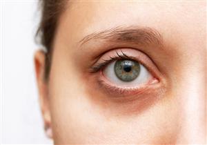 حسب السبب- طبيب يوضح علاج الهالات السوداء تحت العين "فيديو"